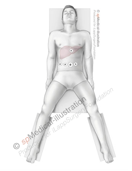 Laparoscopic left hemihepatectomy