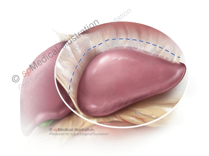 Laparoscopic left hemihepatectomy2