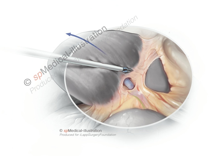 Laparoscopic left hemihepatectomy3