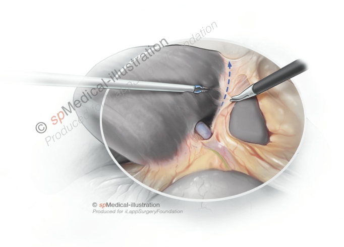 Laparoscopic left hemihepatectomy4