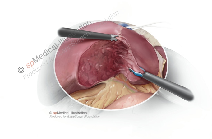 Laparoscopic left hemihepatectomy10