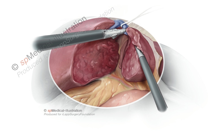 Laparoscopic left hemihepatectomy11