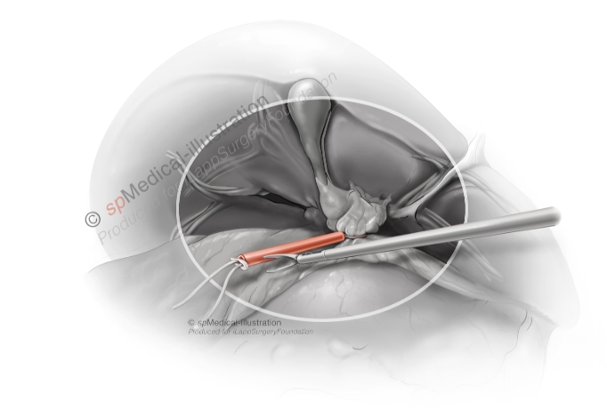 Laparoscopic right hemihepatectomy