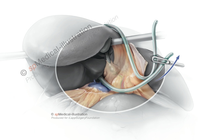Introduction to Major Hepatectomy