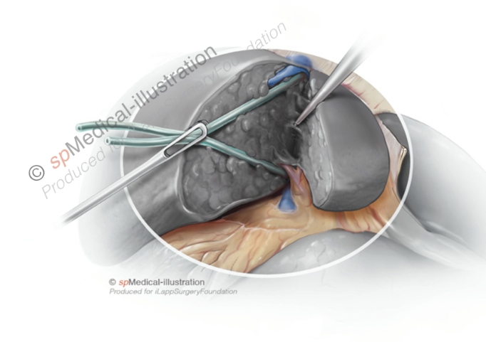 Introduction to Major Hepatectomy2