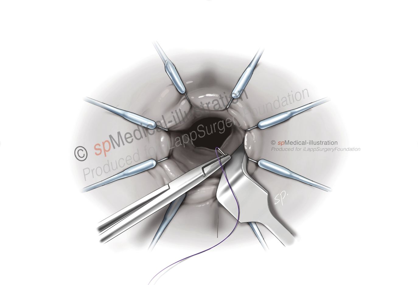 optimal pursestring2