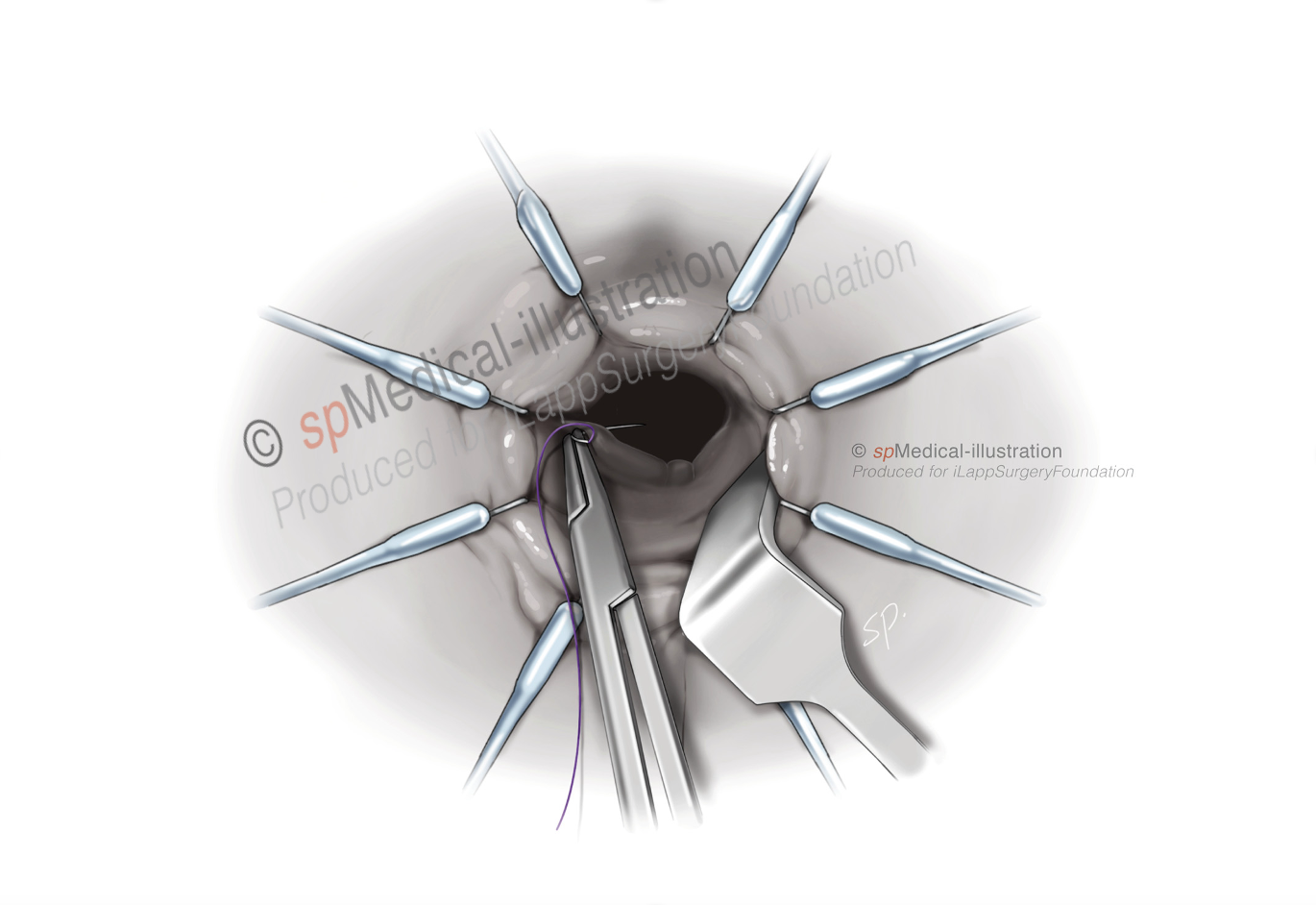 optimal pursestring4