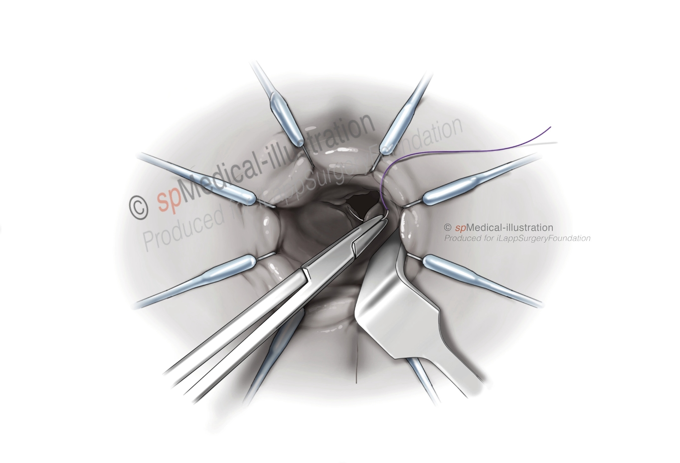 optimal pursestring6