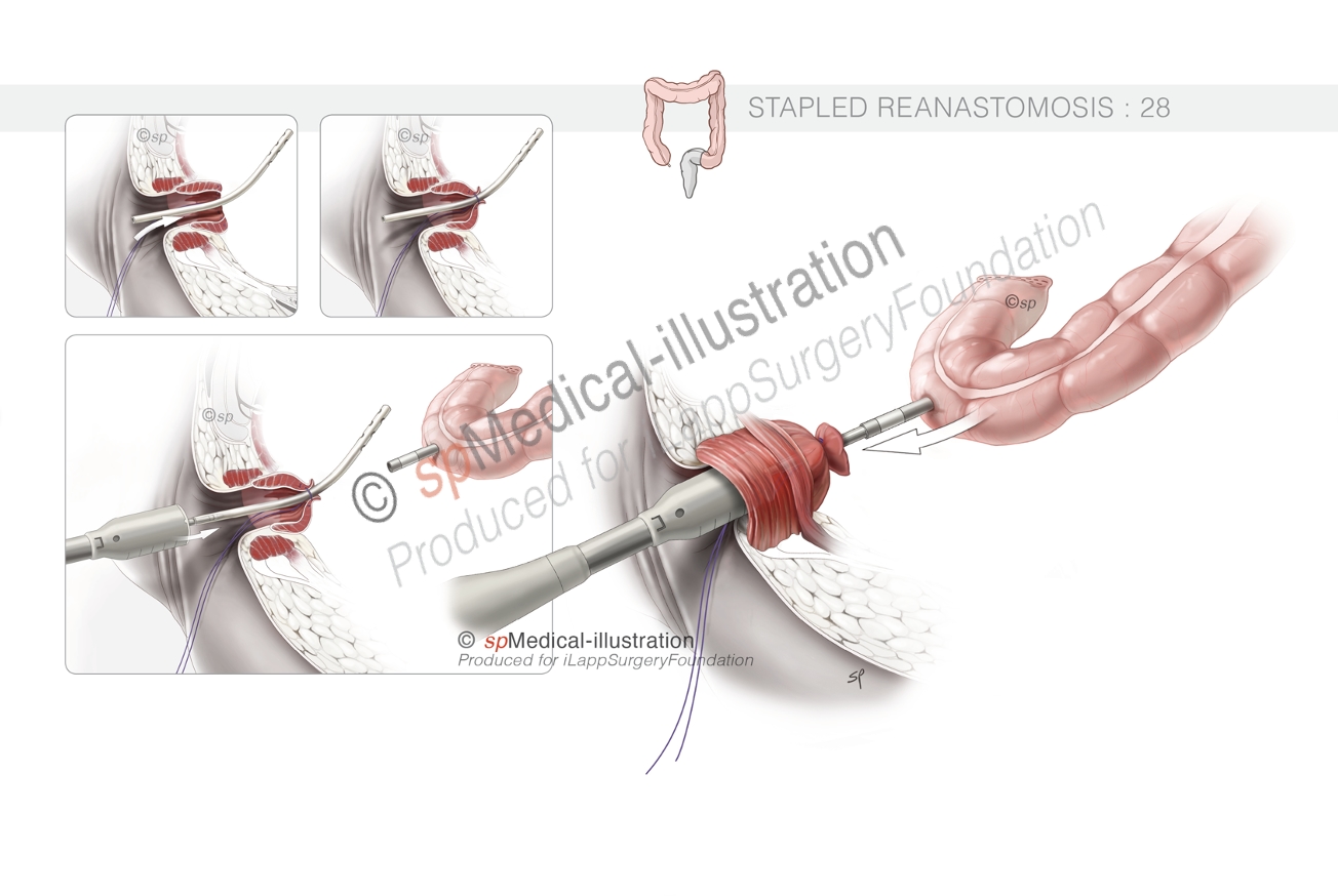 optimal pursestring10