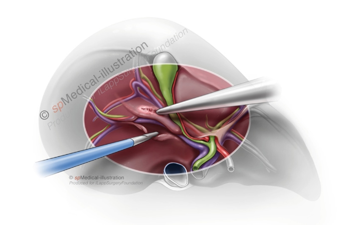 Laparoscopic posterior segmentectomy3
