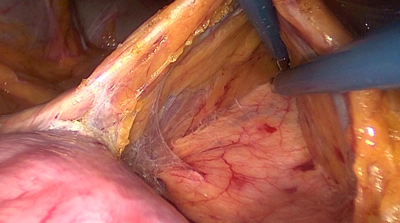 Standardized approach