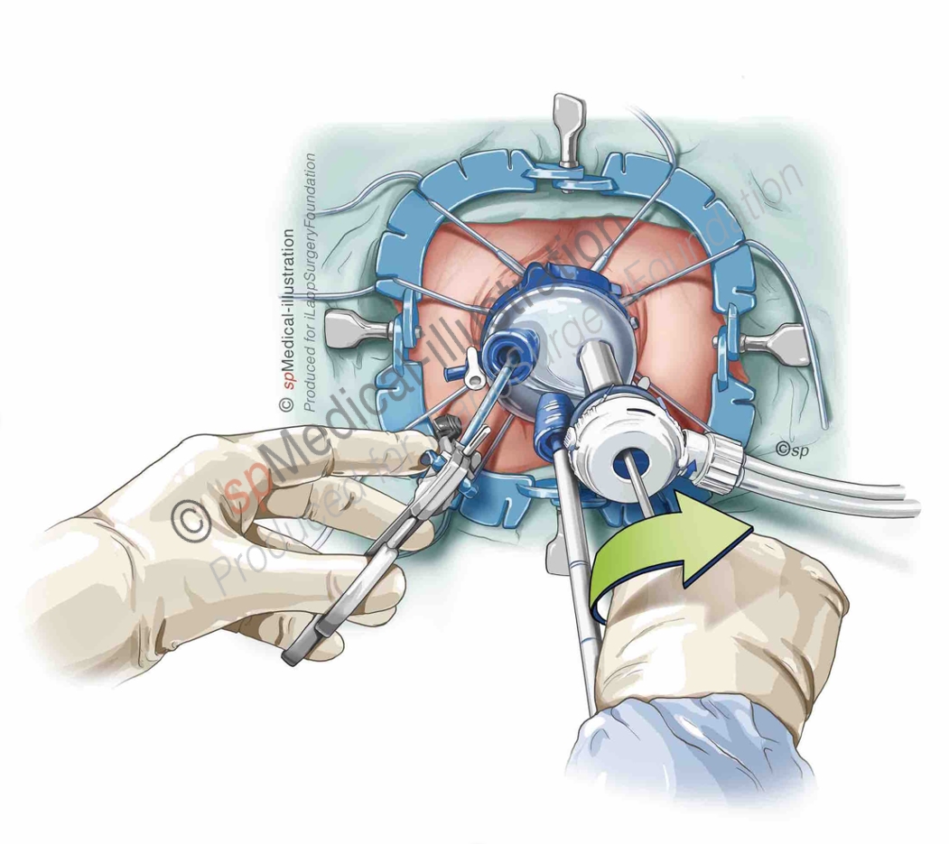 Placement of Pursestring