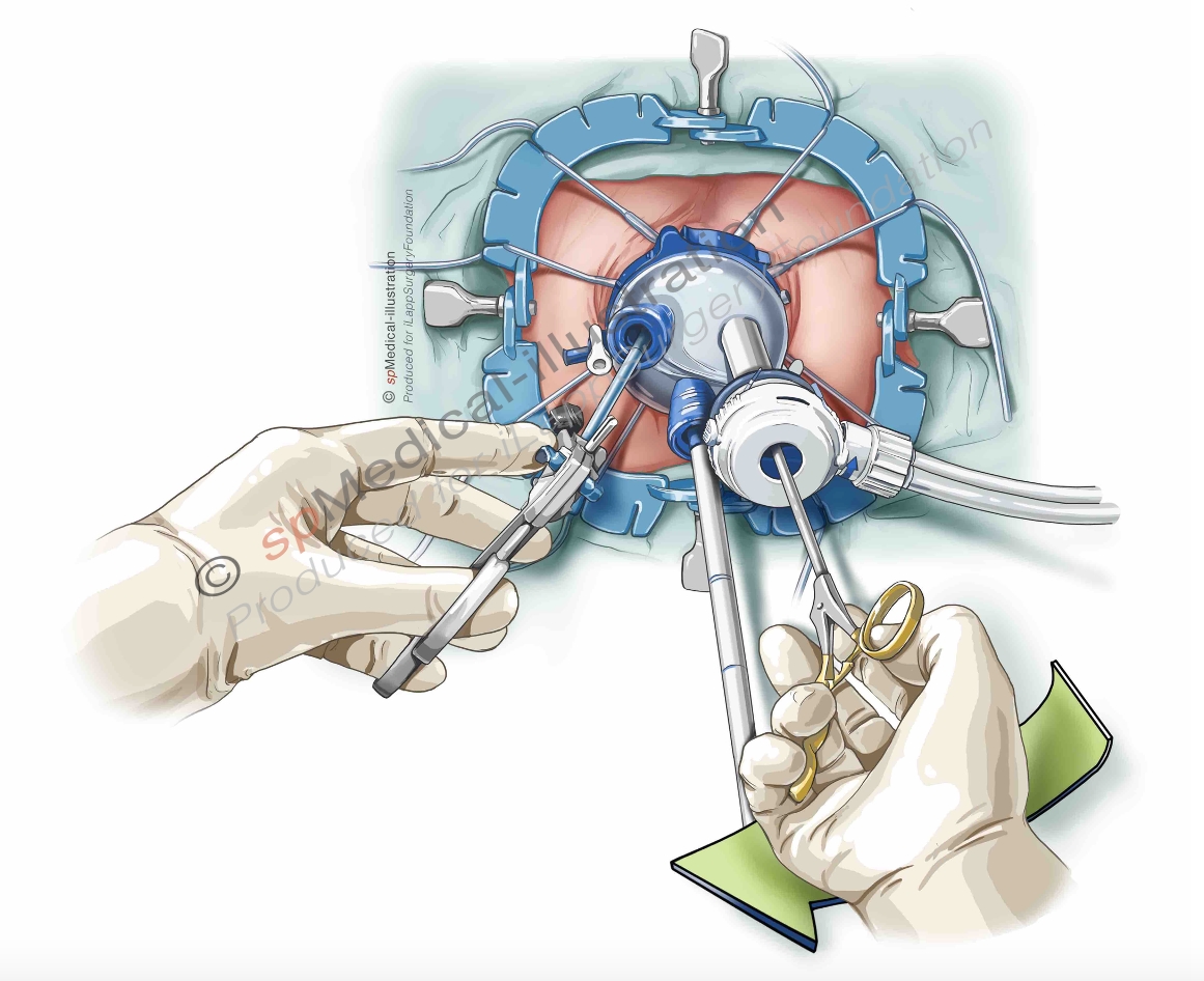 Placement of Pursestring2