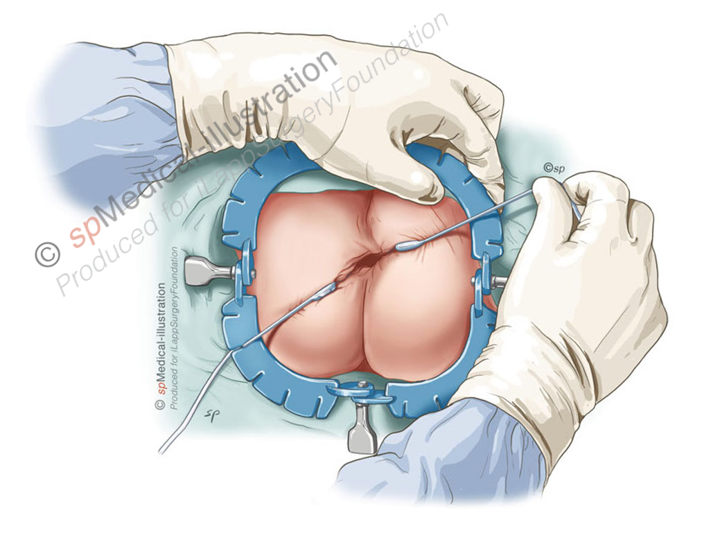 hooks are carefully placed 1