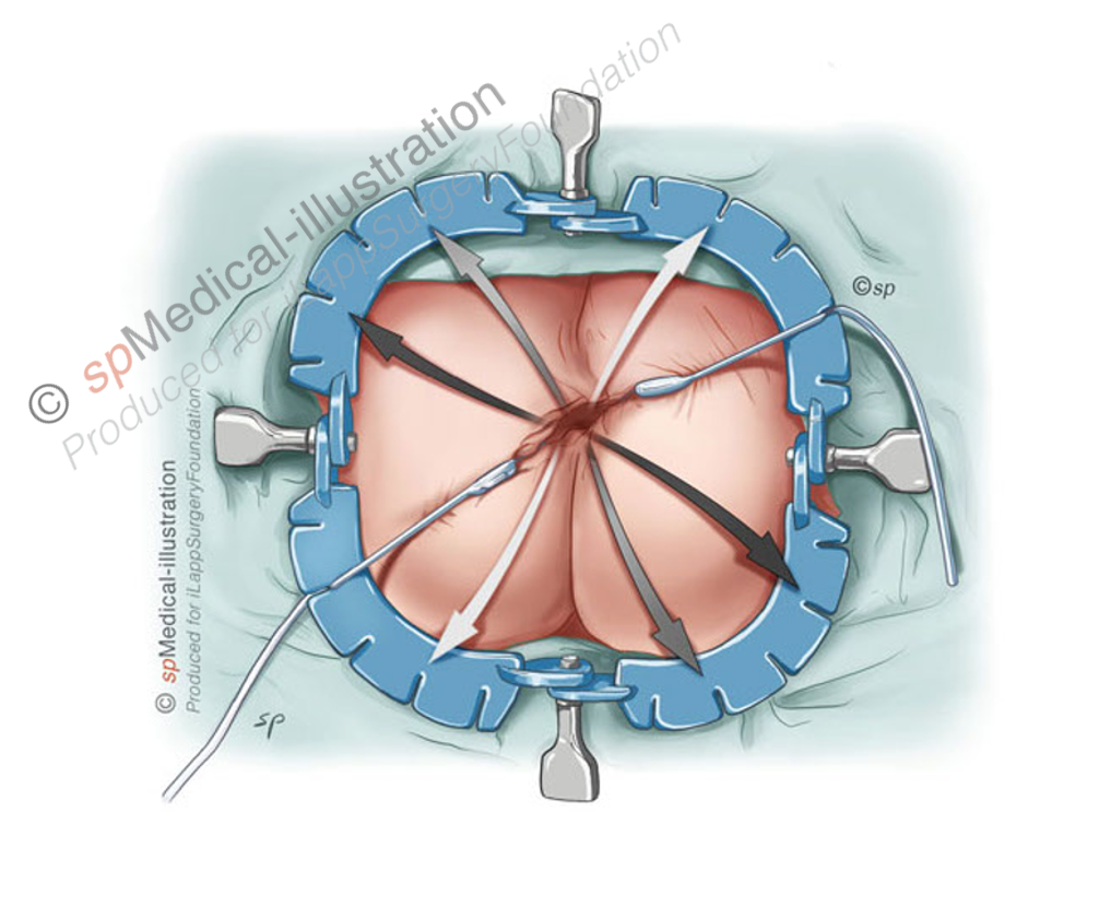 hooks are carefully placed 2