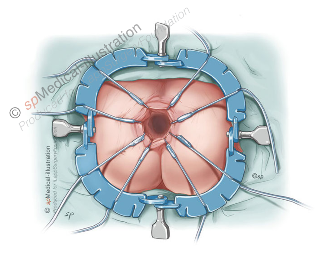 hooks are carefully placed 3