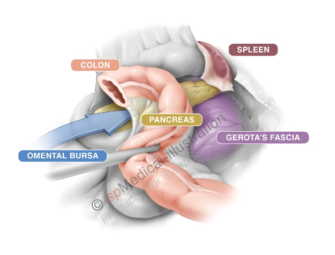 Phase II: Completion of splenic flexure mobilization