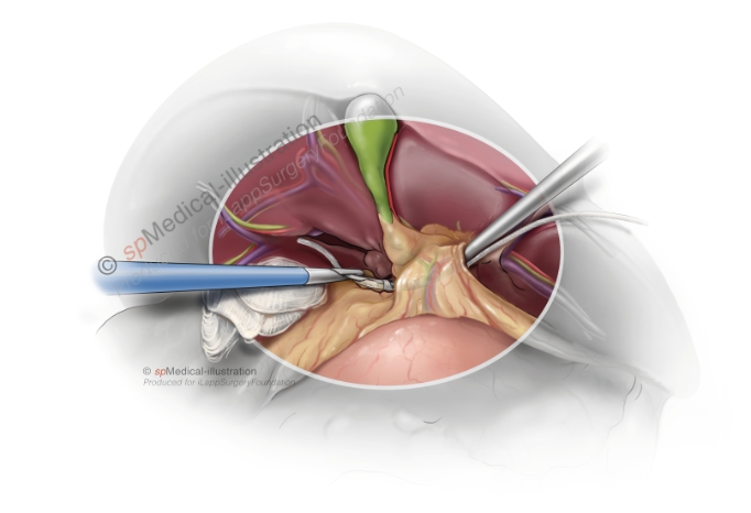 tekening - Laparoscopic Pringle Manoeuvre 