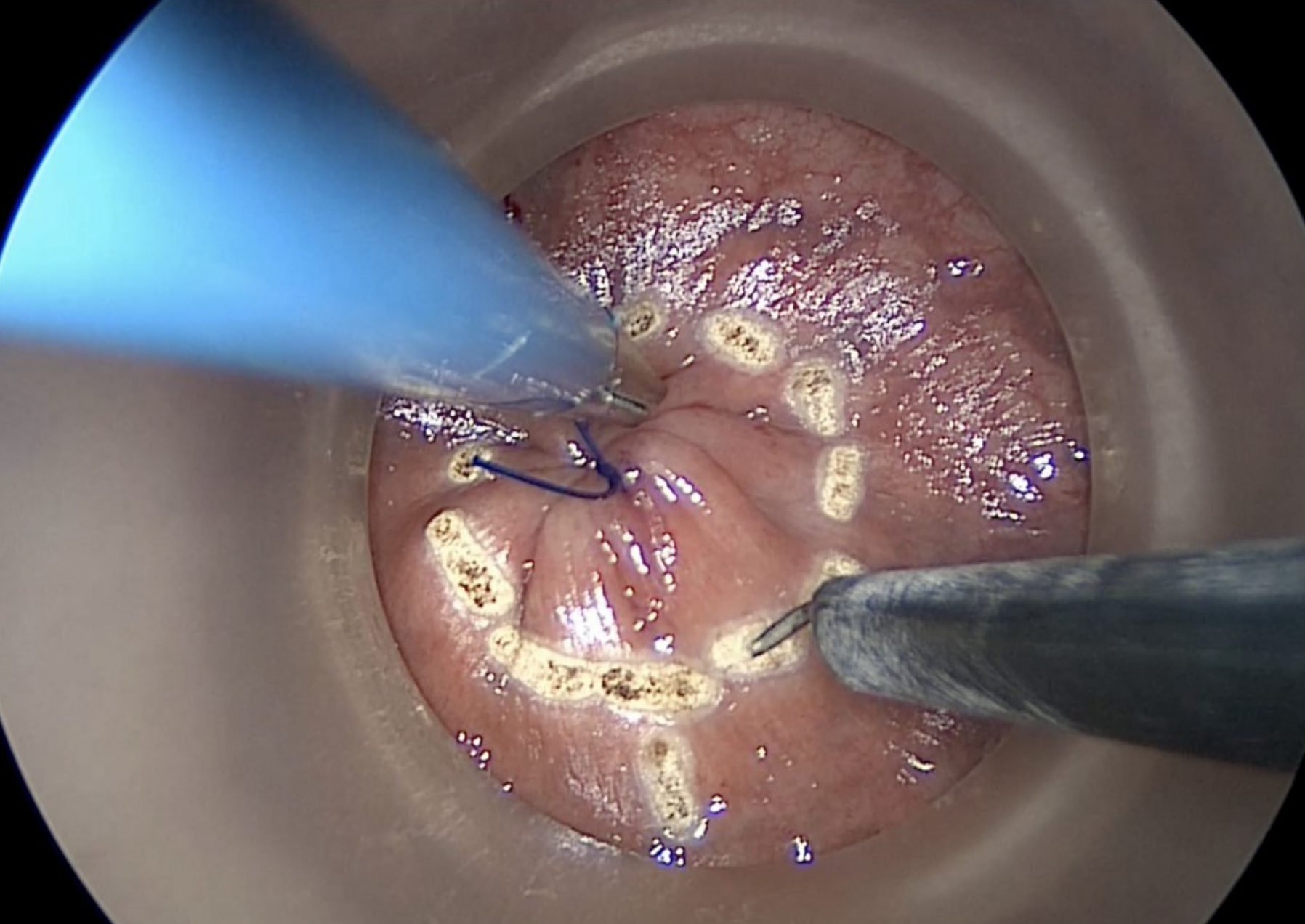 Transanal technique3