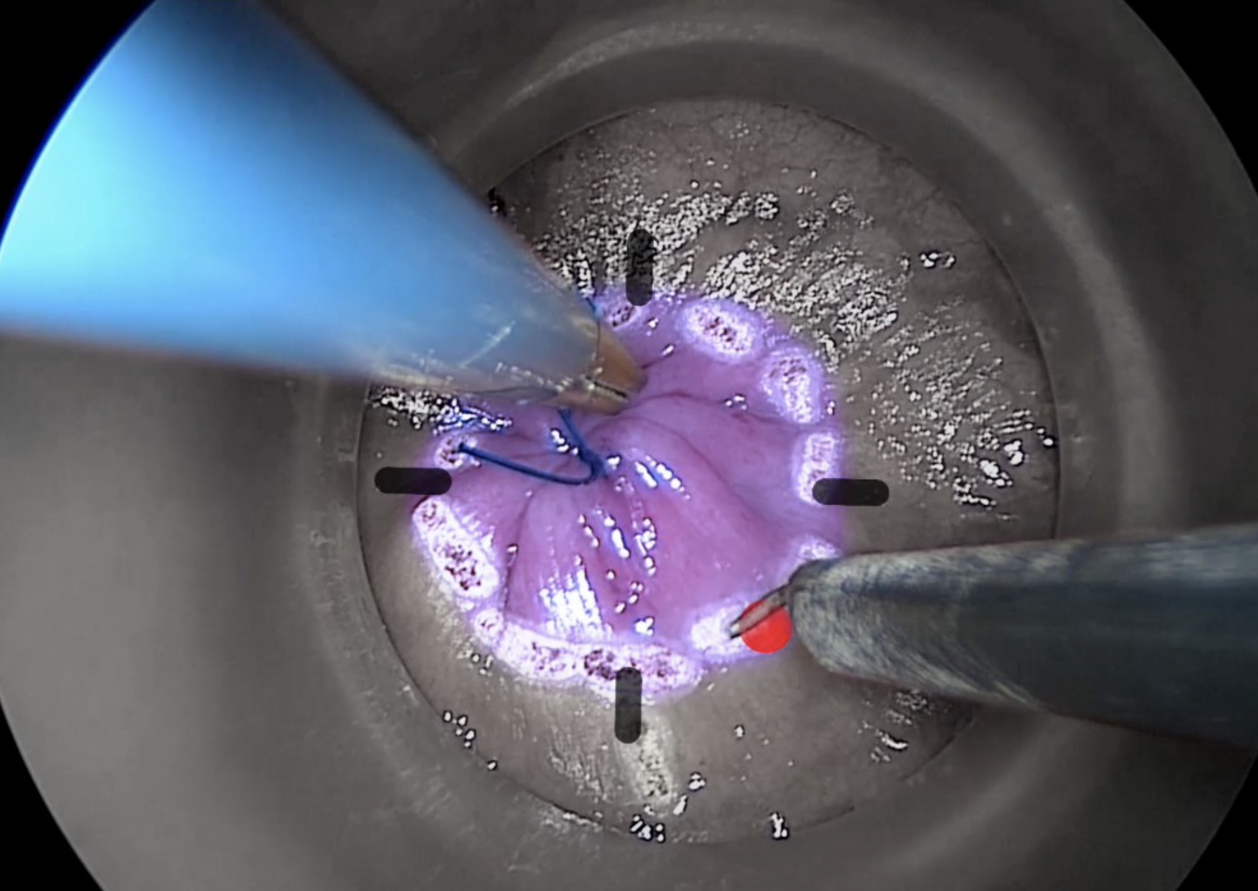 Transanal technique4