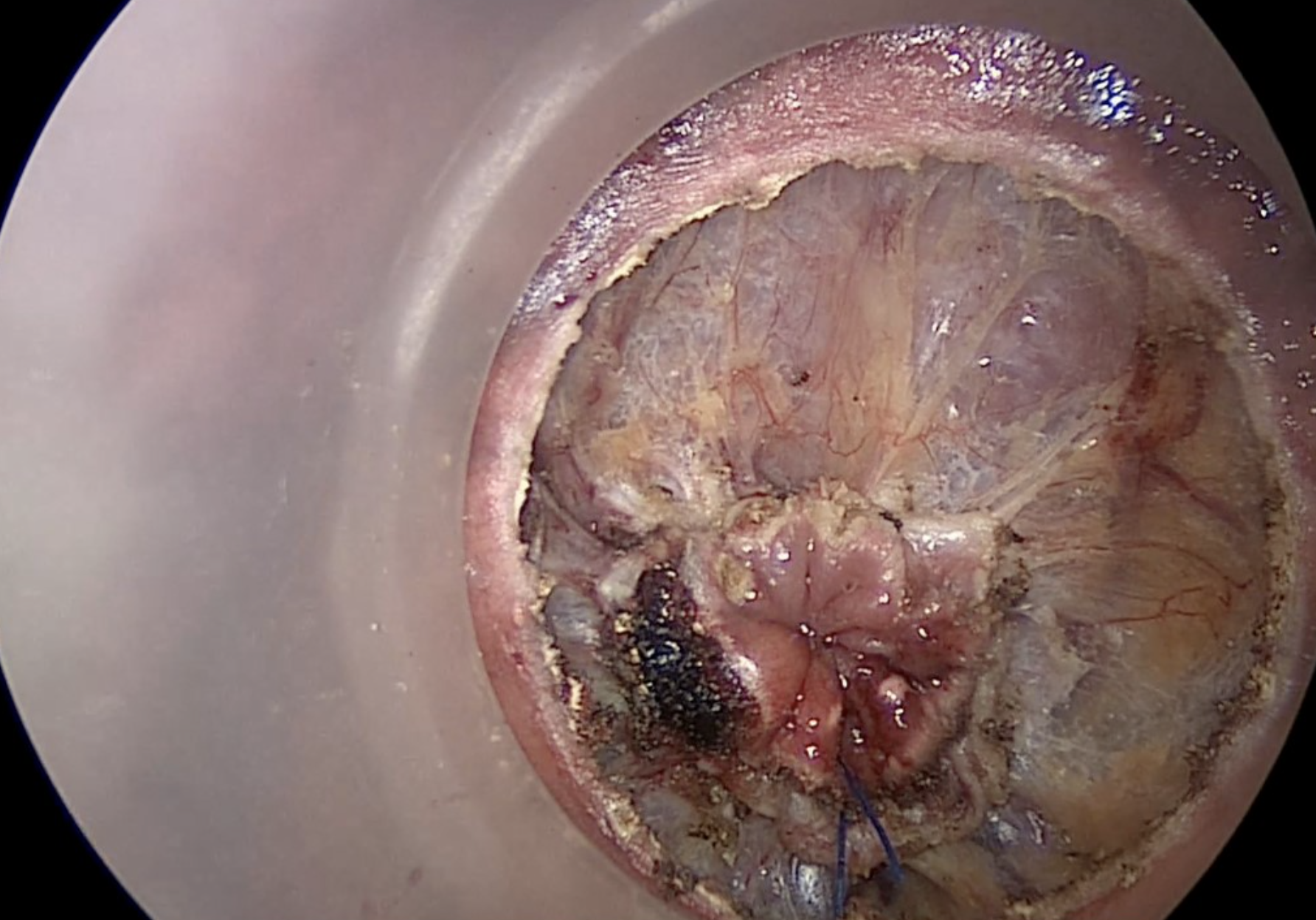 Transanal technique7