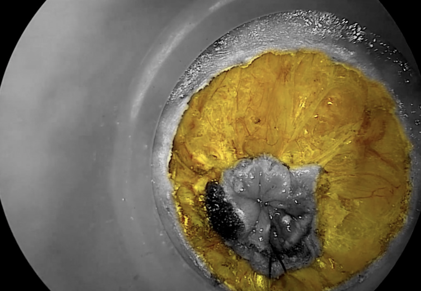 Transanal technique8