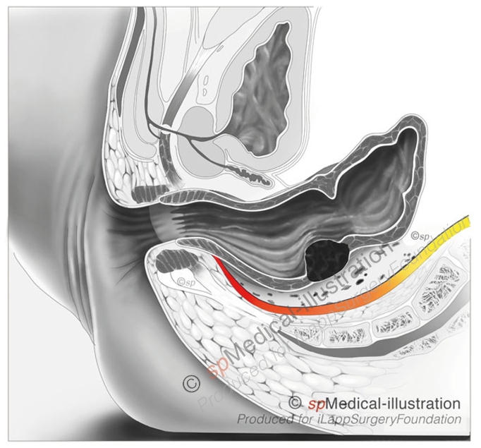 Better visualization of nerve bundles