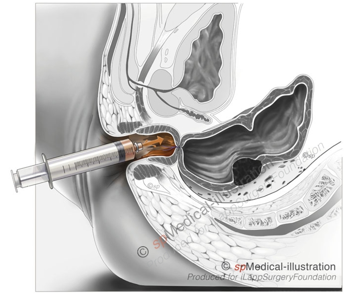 Possibility for improved washout