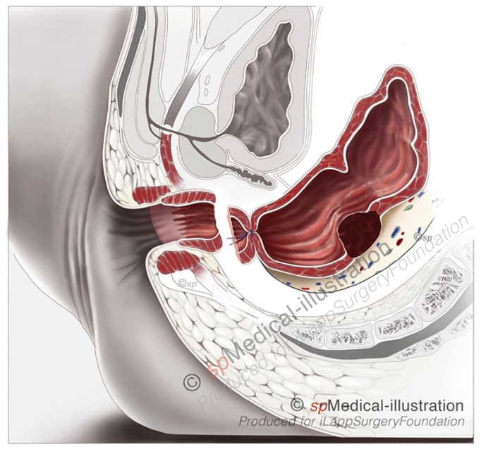 Avoiding imperfect distal stapling