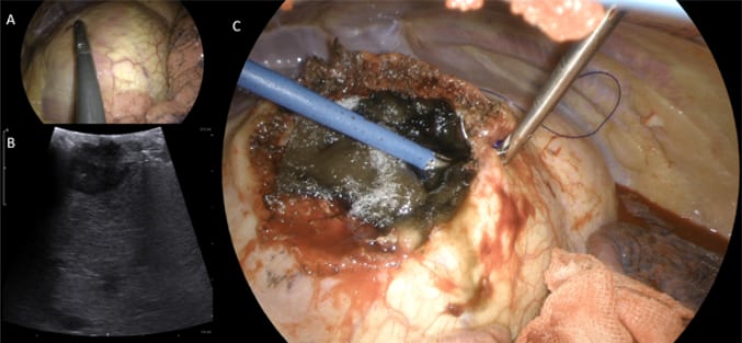 FOTO Introduction to difficult posterosuperior segments