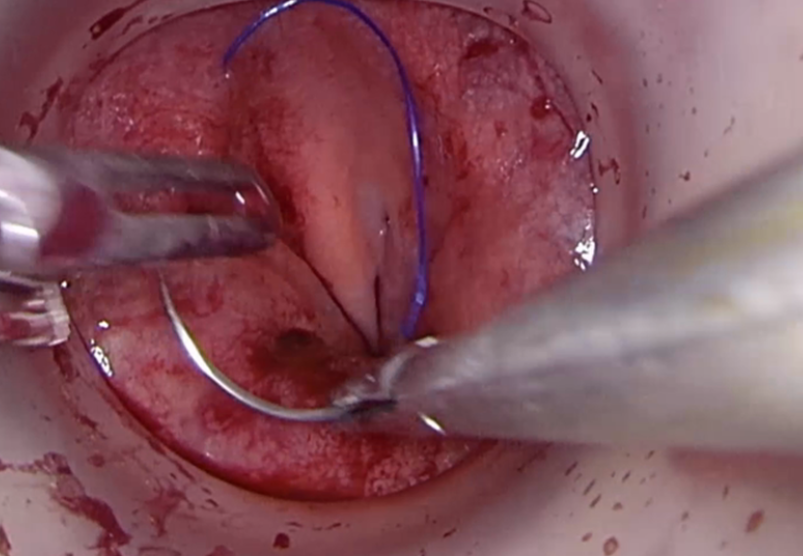 Placement of Pursestring4