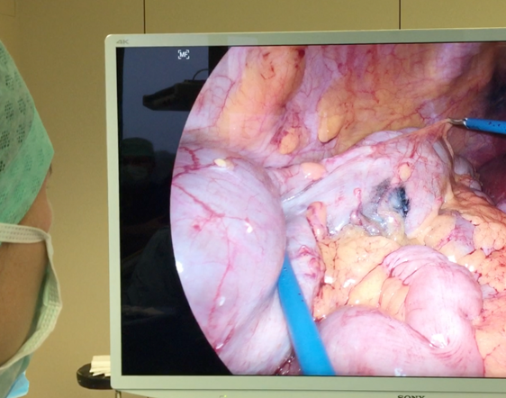 foto van operatie laparoscopy