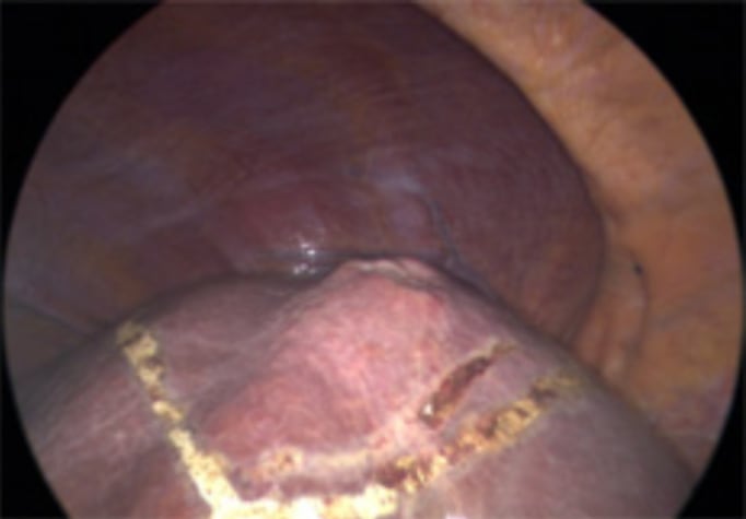 foto - Semiprone position: step by step 