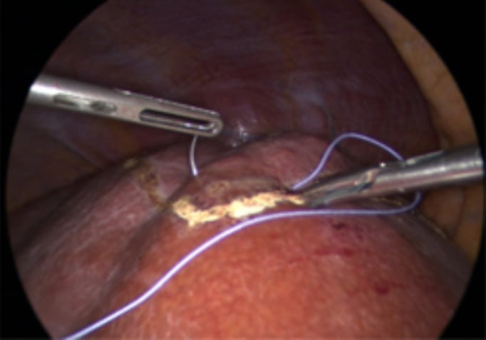 foto - Semiprone position: step by step 2