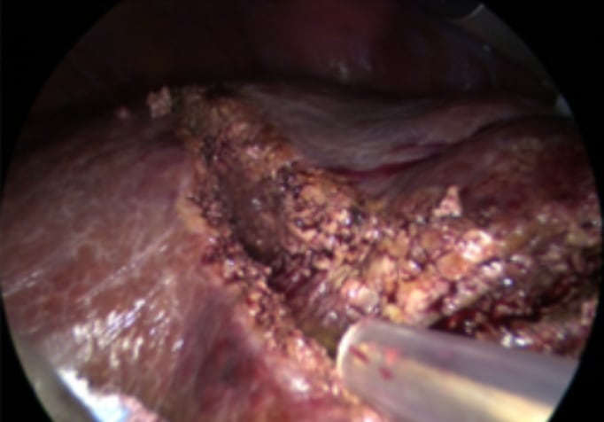 foto - Semiprone position: step by step 4