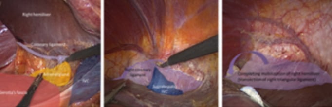 foto - Semiprone position: step by step 6