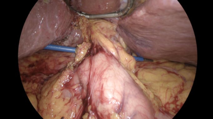 Laparoscopic Pringle Manoeuvre 