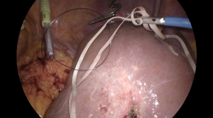 Laparoscopic Pringle Manoeuvre 3