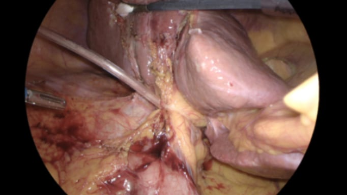 Laparoscopic Pringle Manoeuvre 5