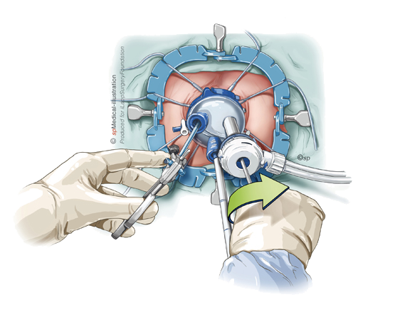 tekening van laparoscopy